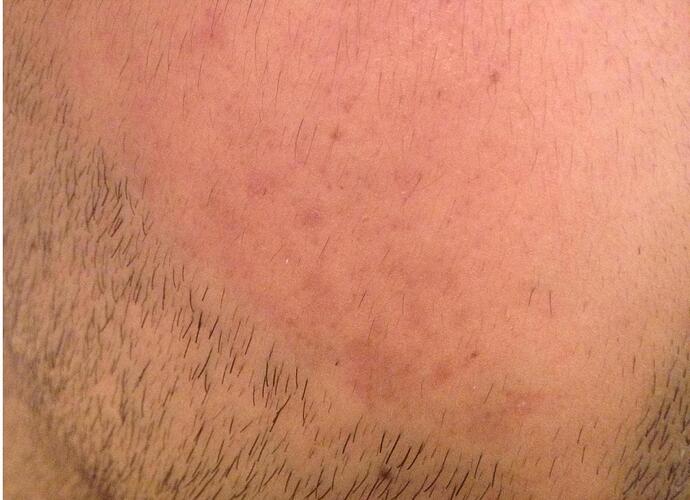cheeks11days.jpg