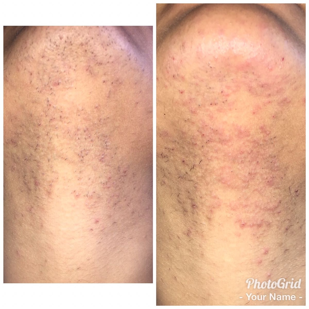 Electrolysis before and after results for PCOS related hirsutism - 1 year  progress and I'm thrilled with the outcome! Started with 30 minute sessions  every 2 weeks, only recently reduced to 15