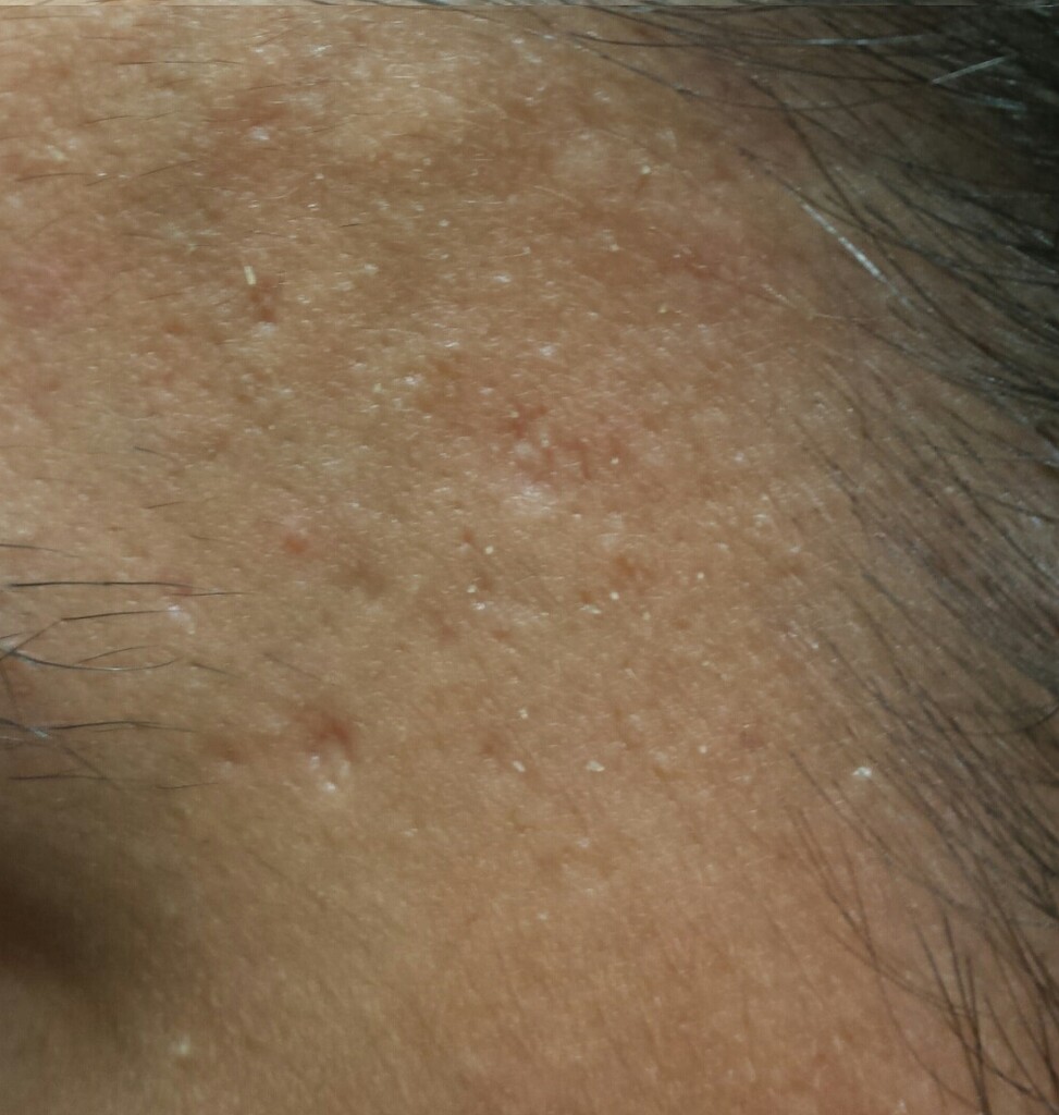 Does this look like scarring? Professional Electrolysis Hairtell