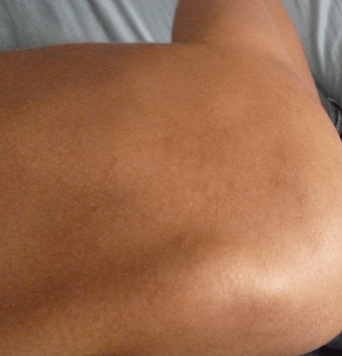 shoulder after 2,5 month .png
