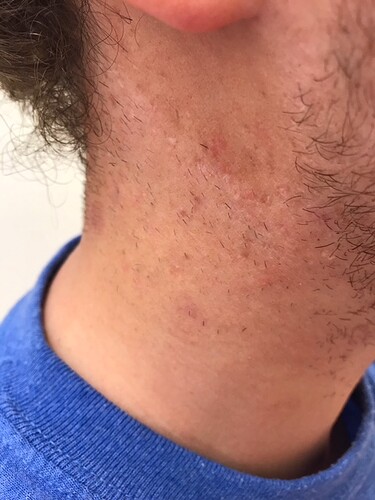 Before1stTreatment