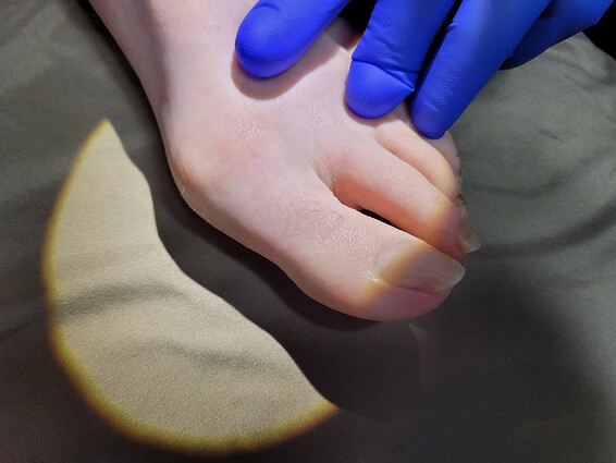 Toes prior to electrolysis (left foot)