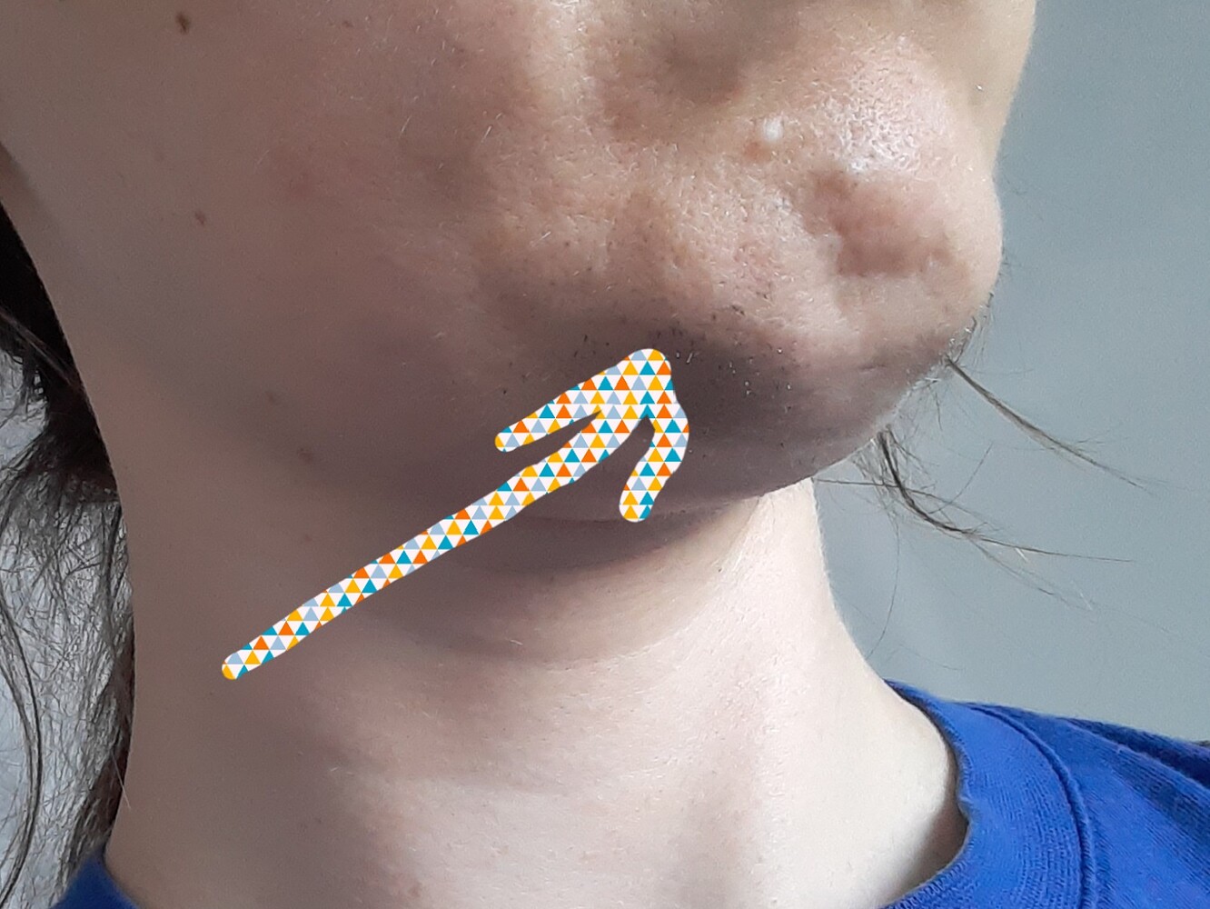 Electrolysis on PCOS girl Electrolysis manufacturers Hairtell hair removal forum by Andrea James