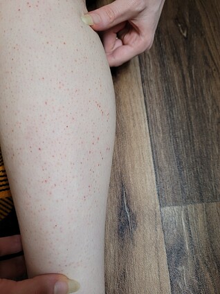 Lower left leg 2.5 hours after electrolysis (3)