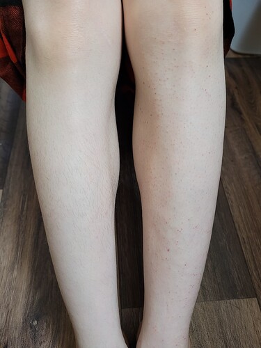 Leg comparison photo!  One leg has been untouched by electrolysis, and the other leg is almost done :3