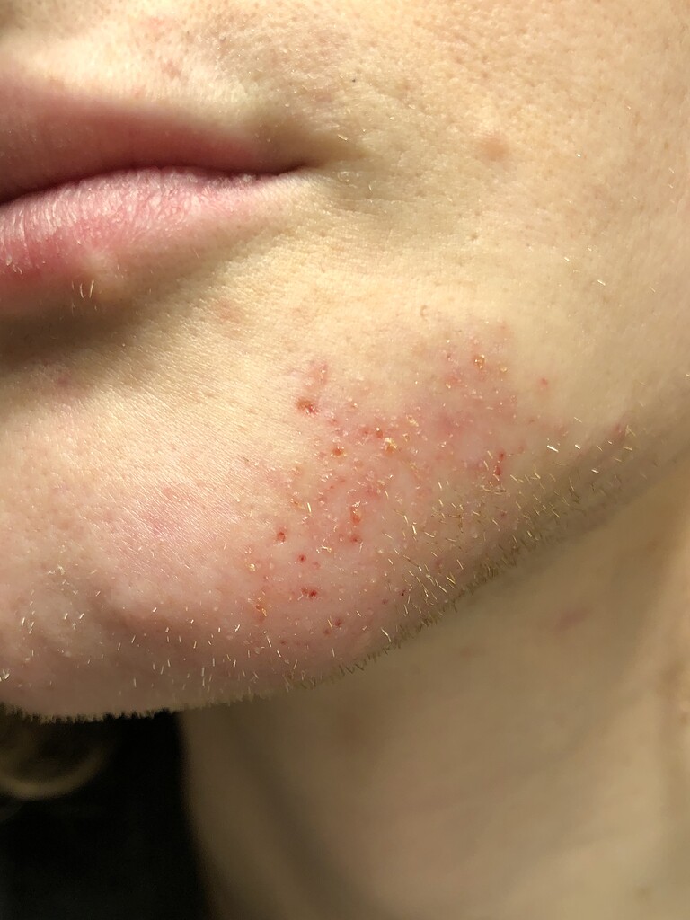 Overtreatment and Damaged Skin? Professional Electrolysis Hairtell