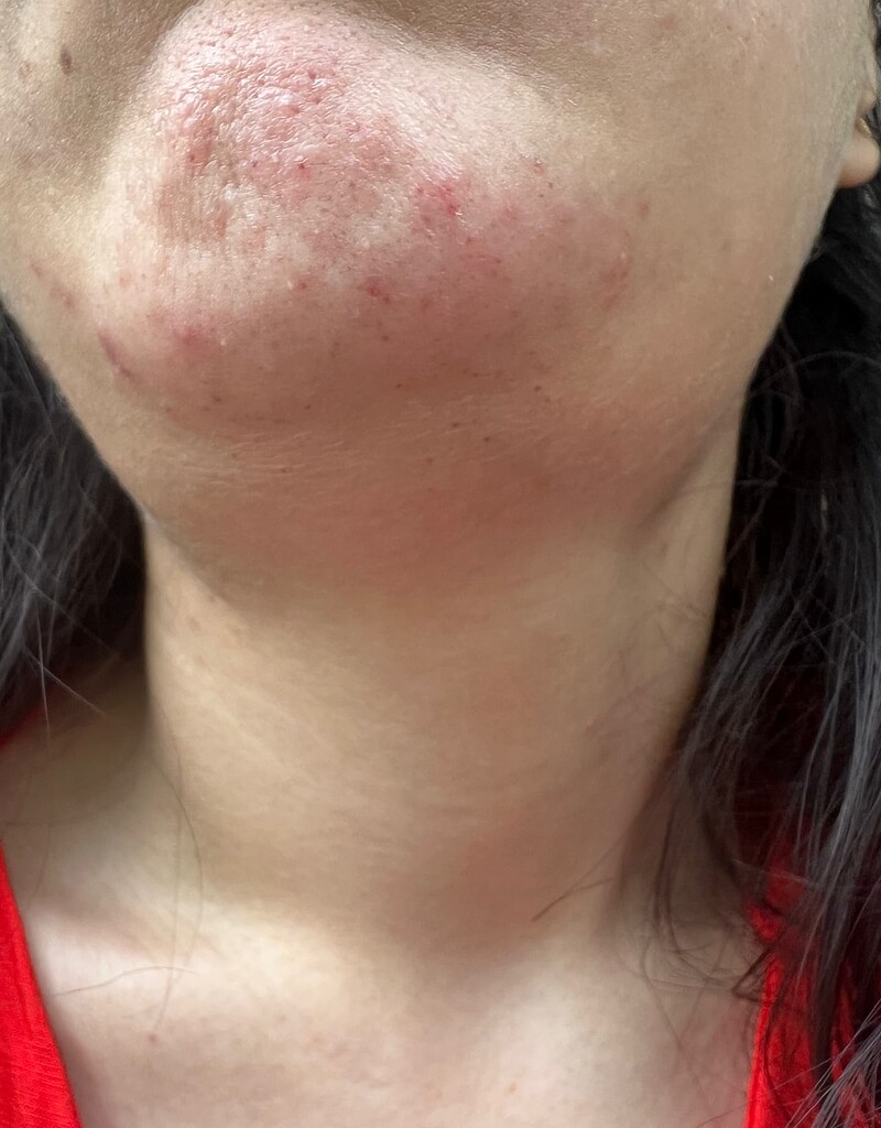 Is there a way to reduce these electrolysis after effects