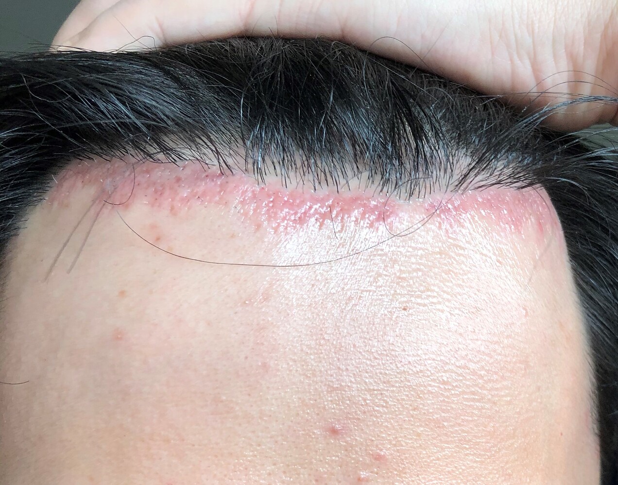 Done my first electrolysis to remove my transplanted hairline. Is