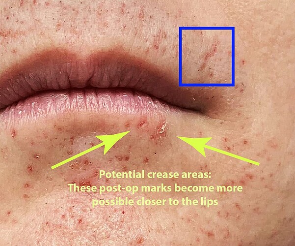 lower lip crease area