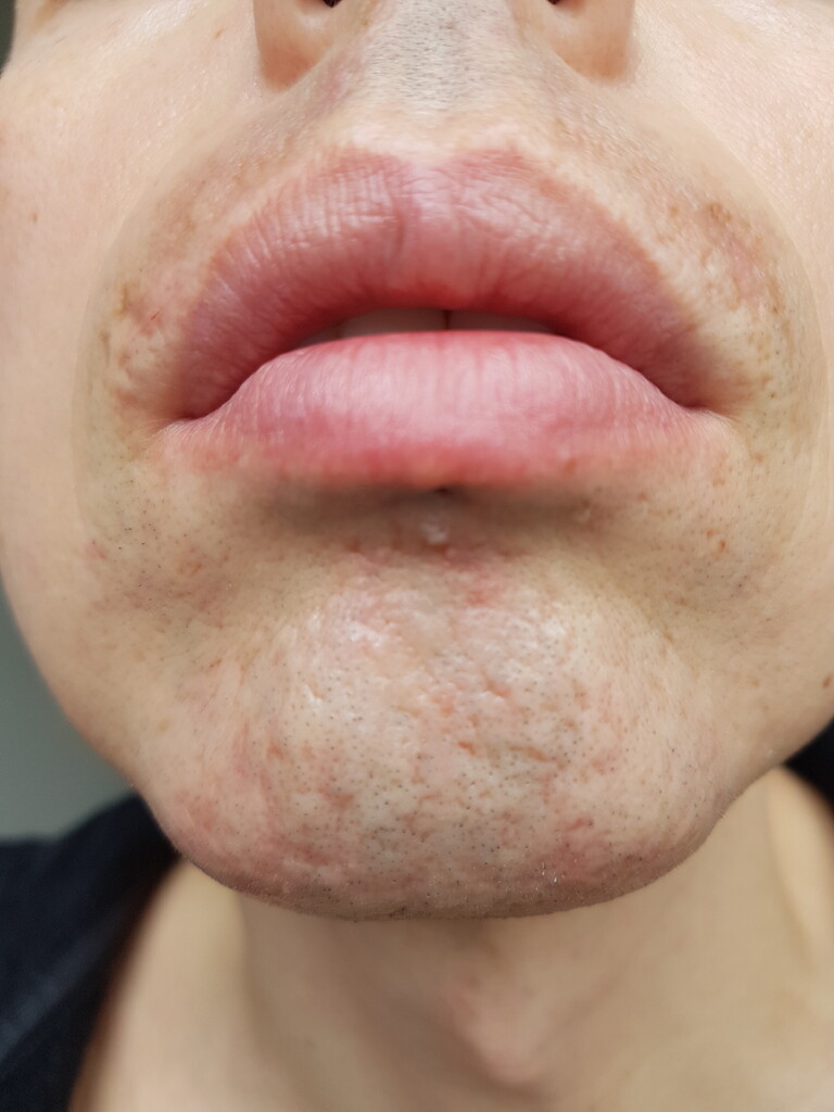 Bad reactions to electrolysis on face or bad technician? - Professional  Electrolysis - Hairtell hair removal forum by Andrea James
