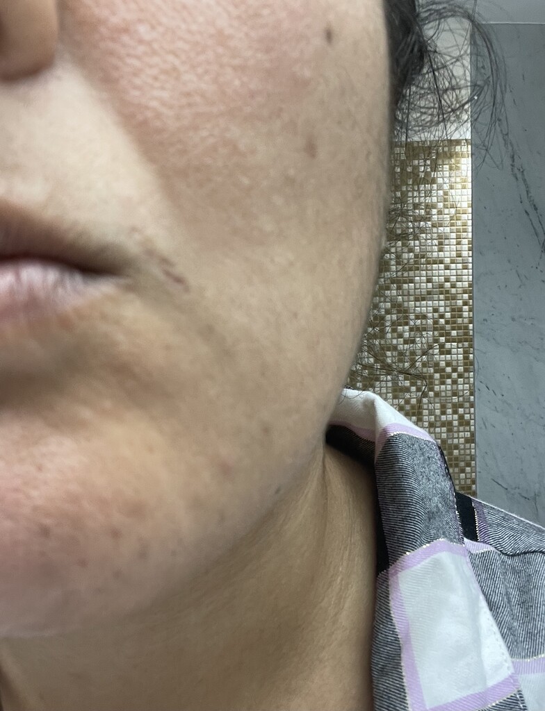 Second post upper lip scars overtreatment Professional Electrolysis