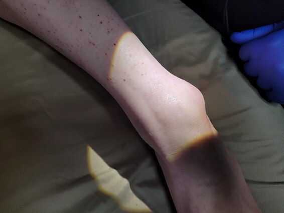 Left ankle prior to electrolysis