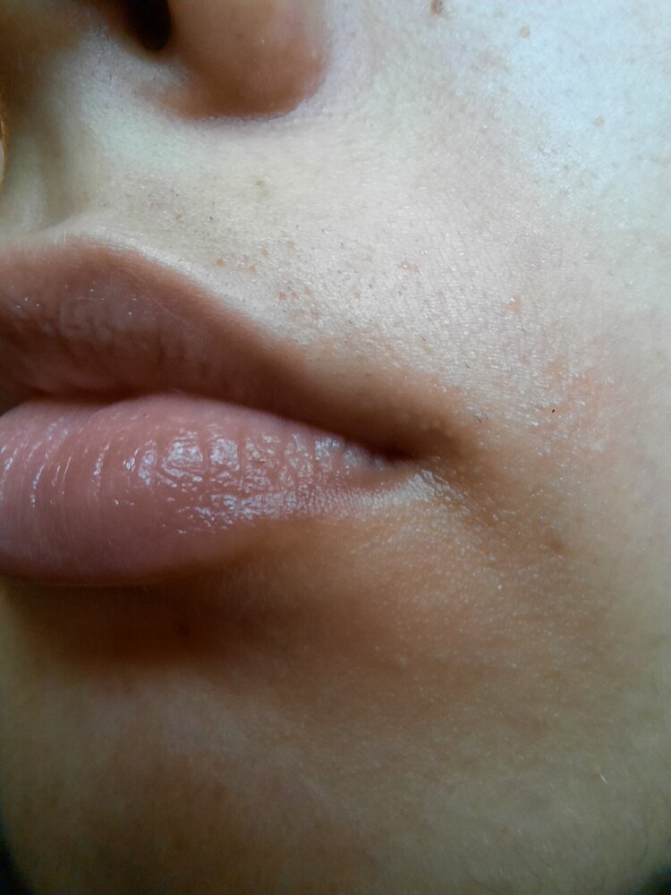 Electrolysis scarring Clearance