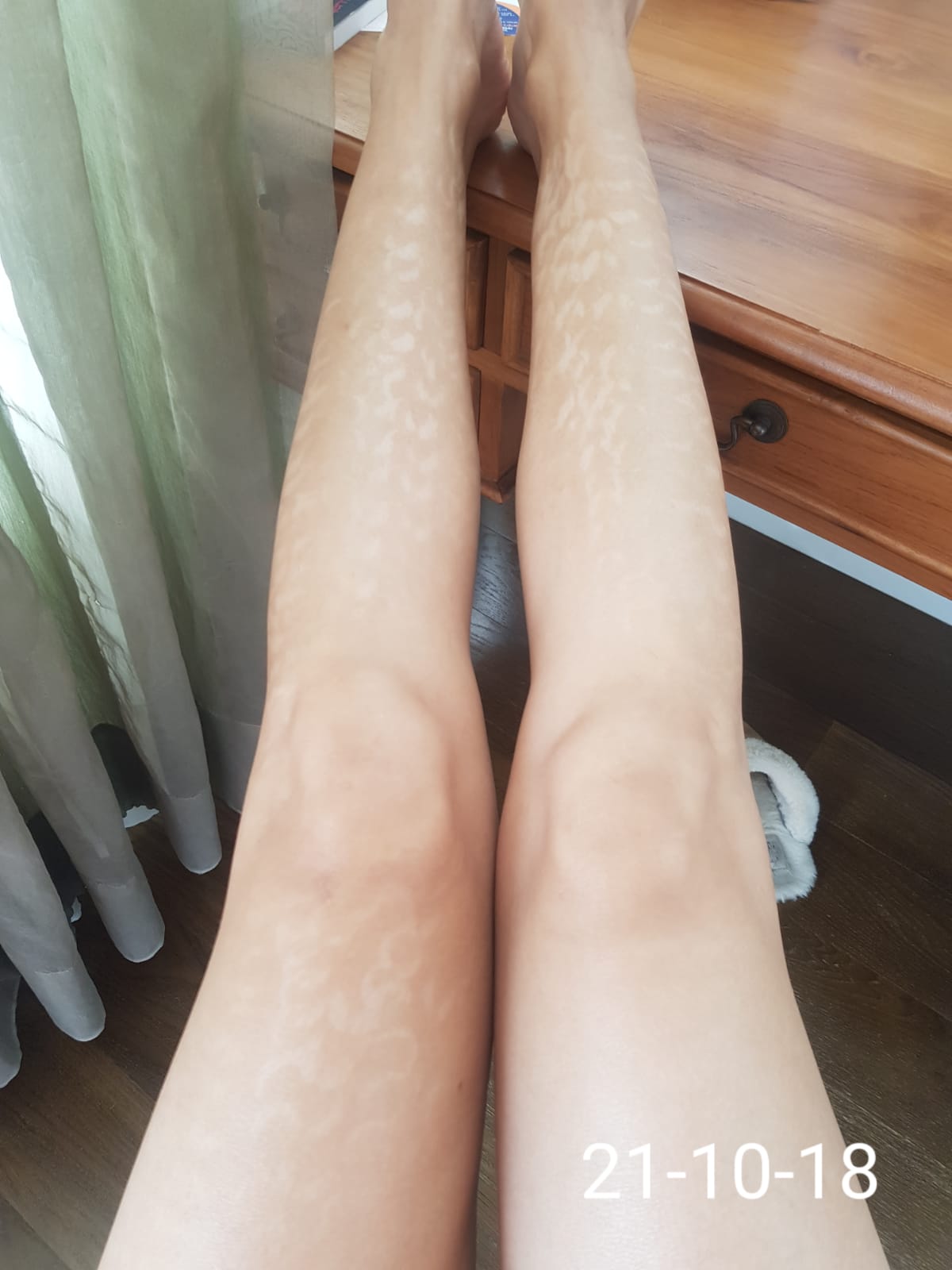 Hypopigmentation after laser treatment burns (photo) - Tips For Skin Care -  Hairtell hair removal forum by Andrea James