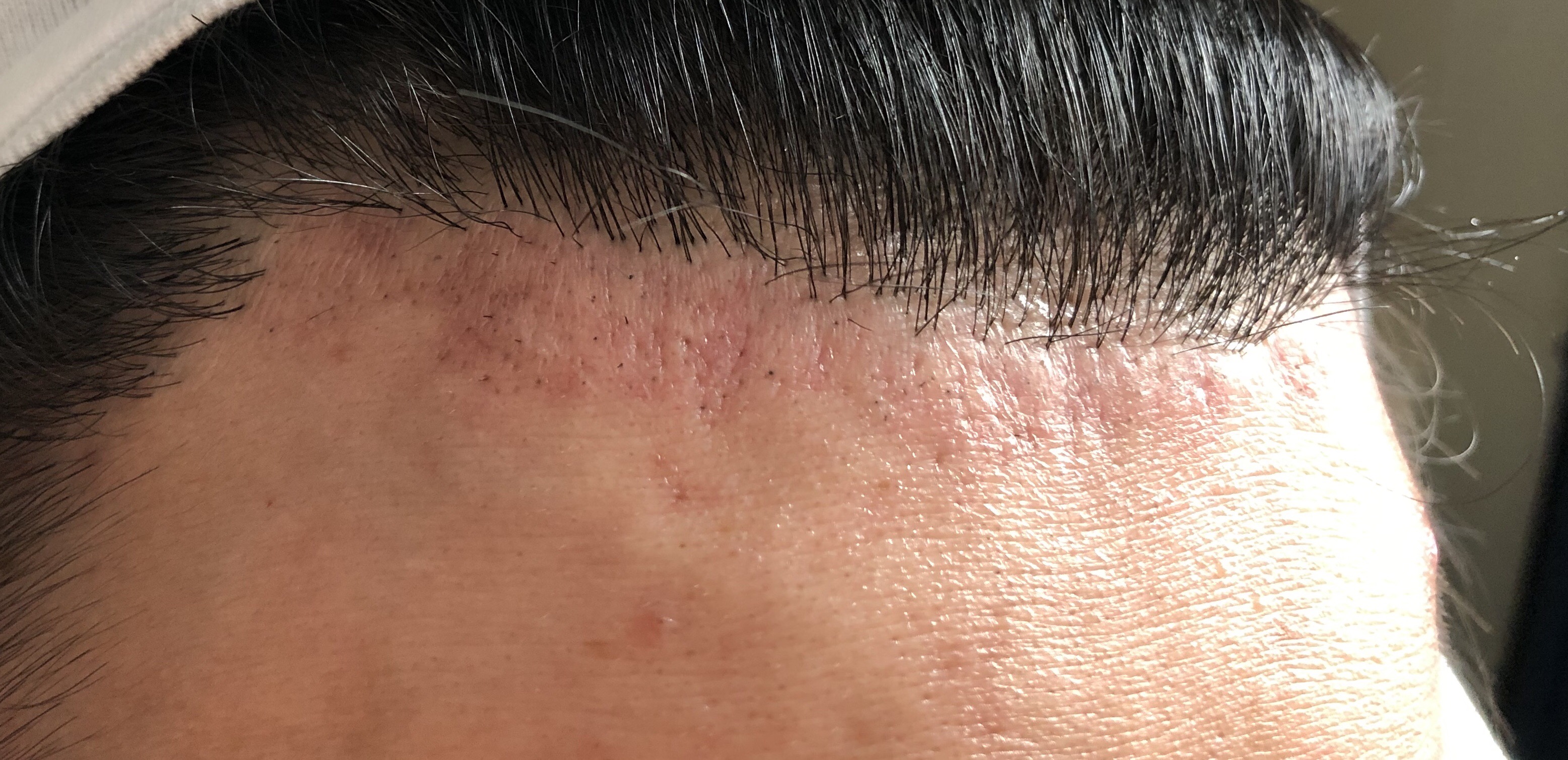 Done my first electrolysis to remove my transplanted hairline. Is  everything alright? [keep updating] - Professional Electrolysis - Hairtell hair  removal forum by Andrea James