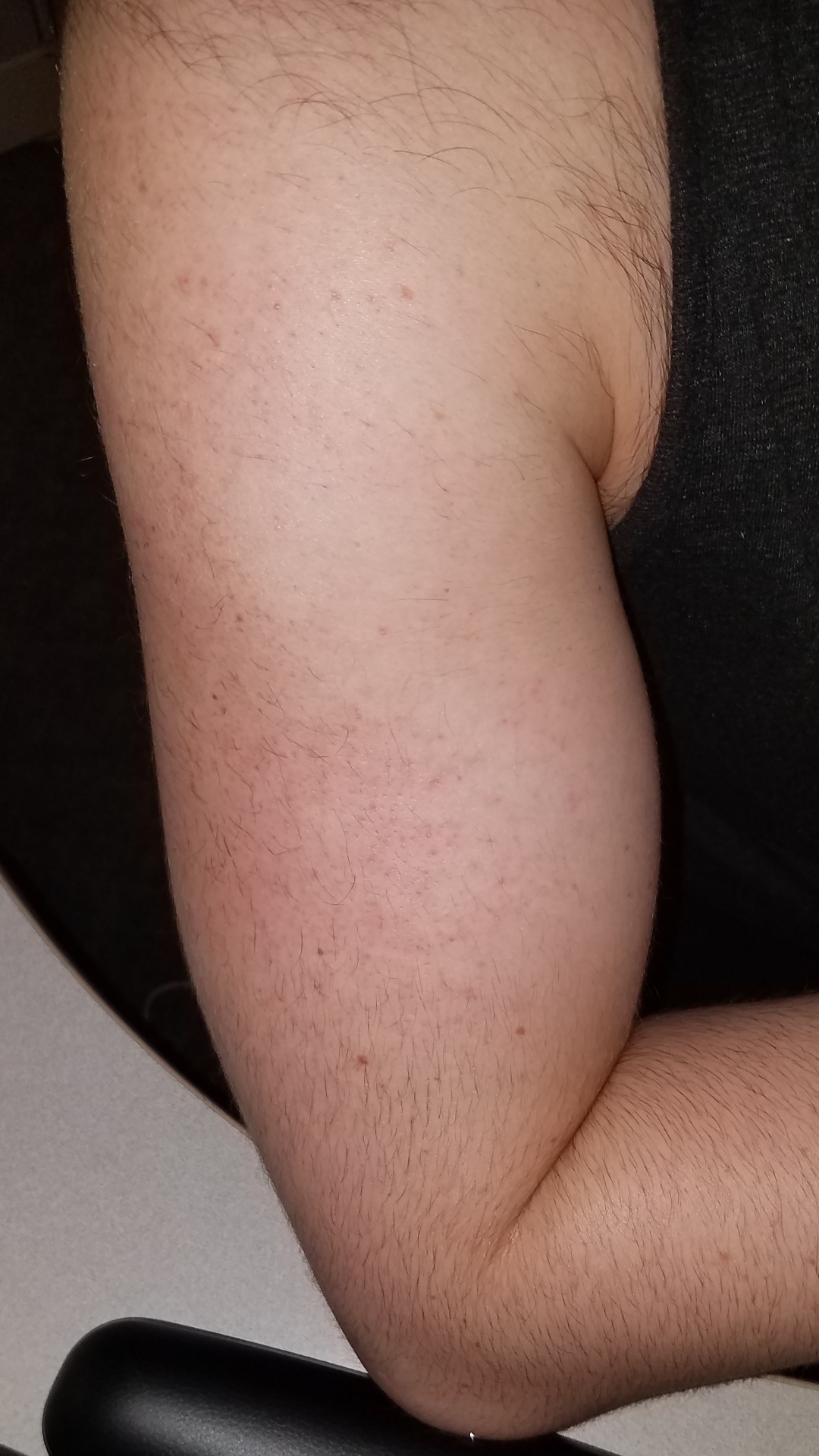 Need advice! Male electrolysis upper arm hair pattern + pictures -  Professional Electrolysis - Hairtell hair removal forum by Andrea James