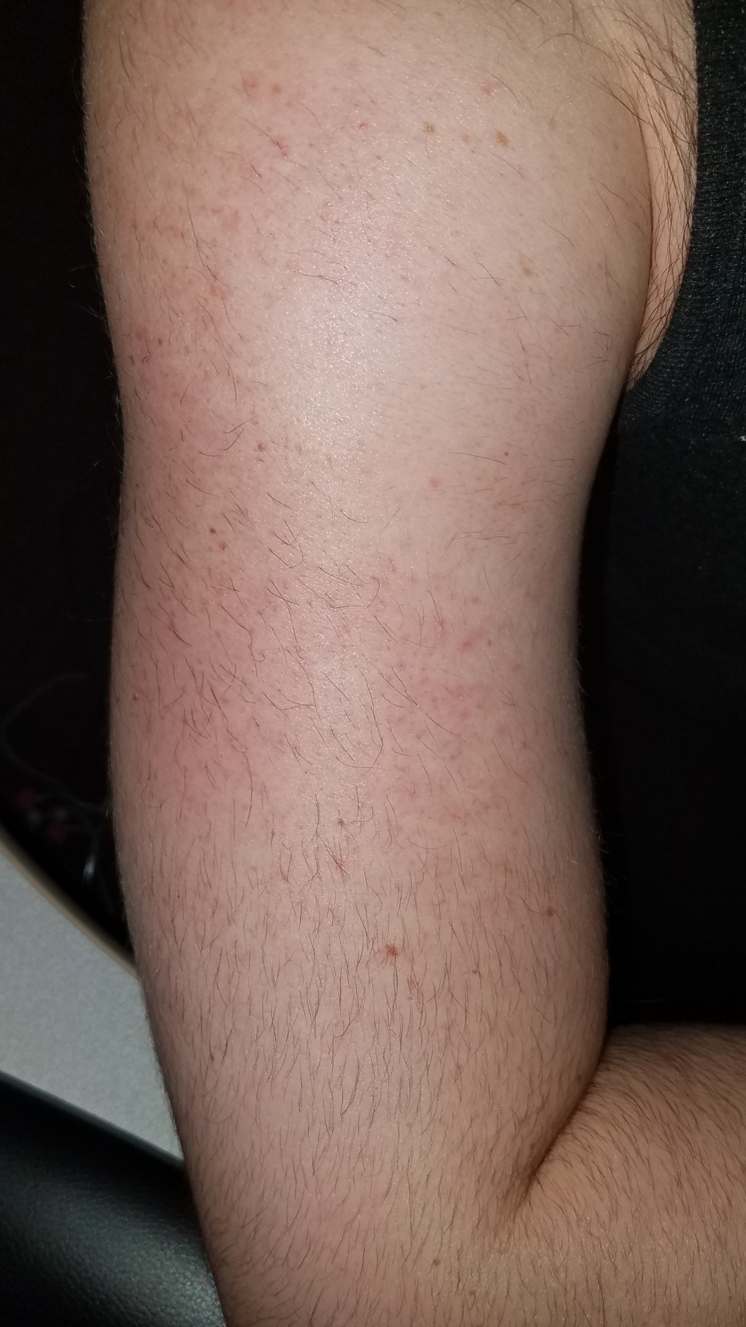 Need advice! Male electrolysis upper arm hair pattern + pictures -  Professional Electrolysis - Hairtell hair removal forum by Andrea James