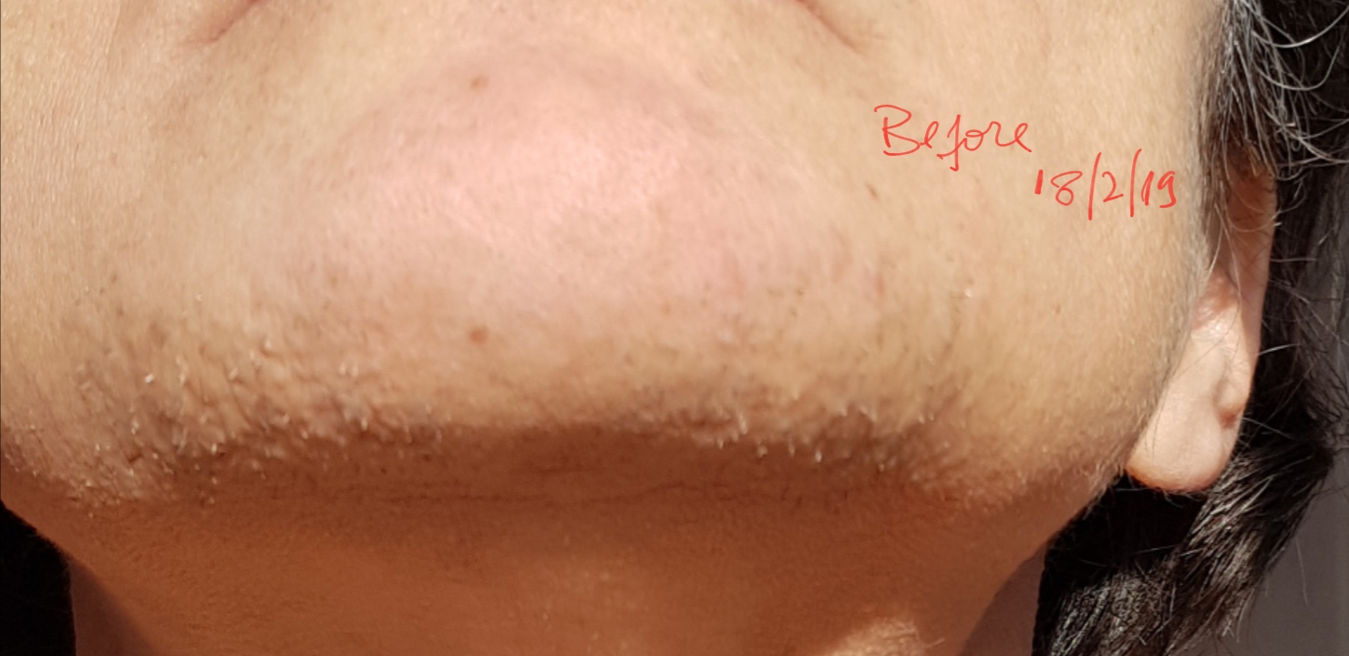 Question about chin hair and scarring post electrolysis - #18 by Iluv2zap -  Professional Electrolysis - Hairtell hair removal forum by Andrea James