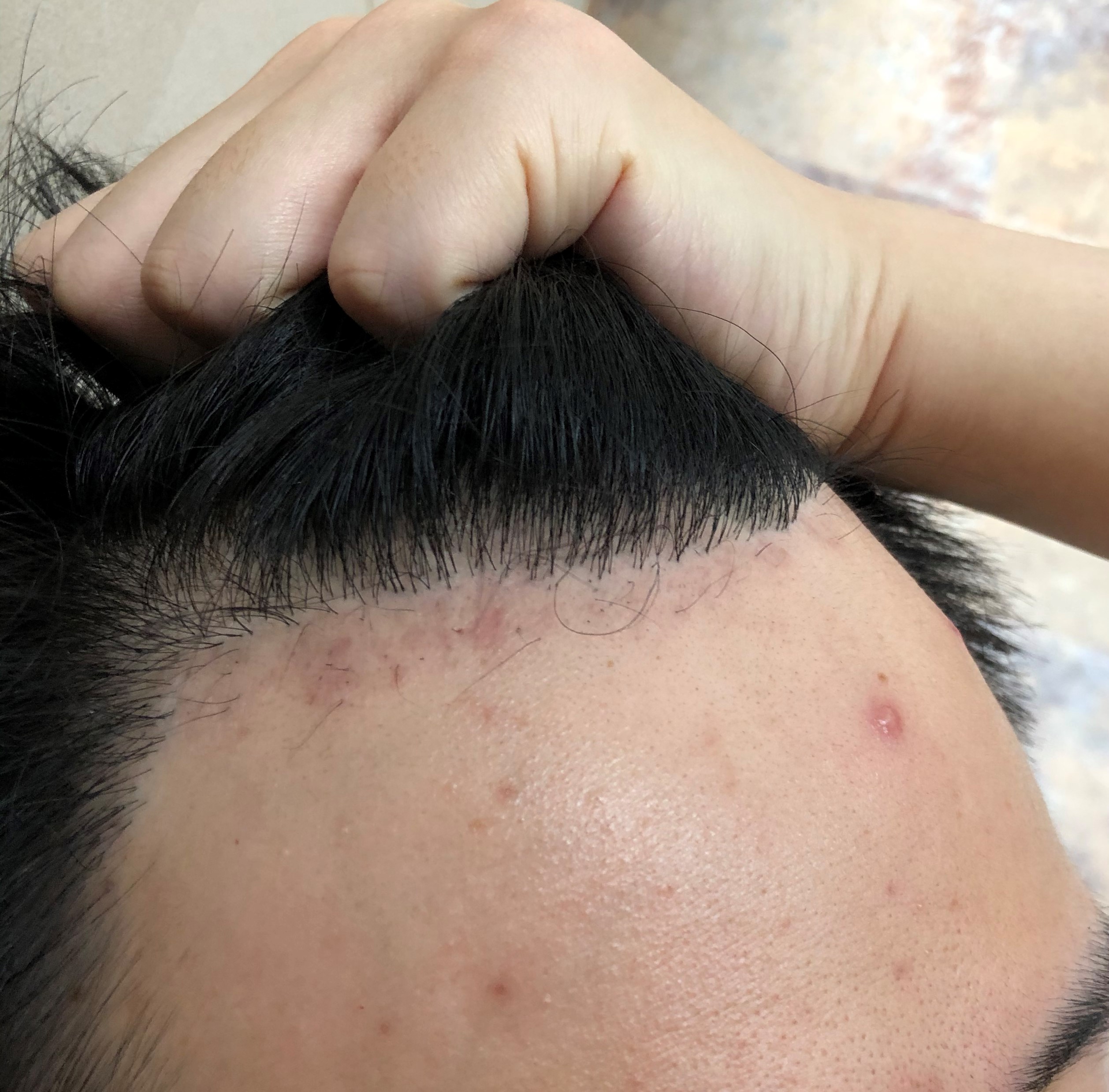 Done my first electrolysis to remove my transplanted hairline. Is  everything alright? [keep updating] - Professional Electrolysis - Hairtell hair  removal forum by Andrea James