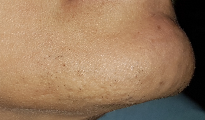 Question about chin hair and scarring post electrolysis - #14 by Iluv2zap -  Professional Electrolysis - Hairtell hair removal forum by Andrea James