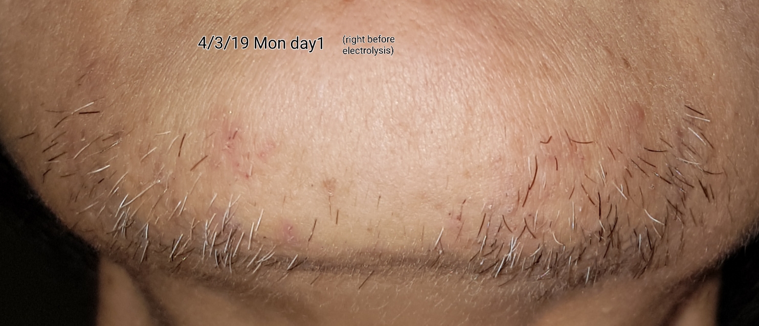 Question about chin hair and scarring post electrolysis - Professional  Electrolysis - Hairtell hair removal forum by Andrea James